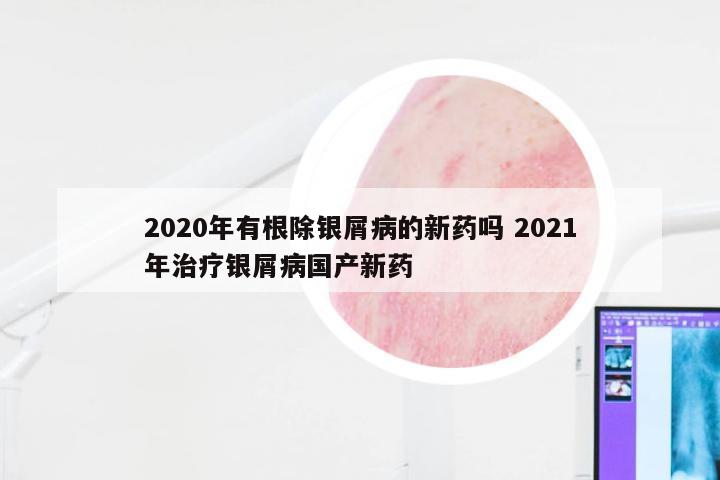 2020年有根除银屑病的新药吗 2021年治疗银屑病国产新药