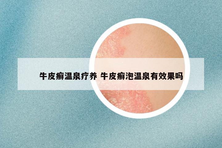 牛皮癣温泉疗养 牛皮癣泡温泉有效果吗