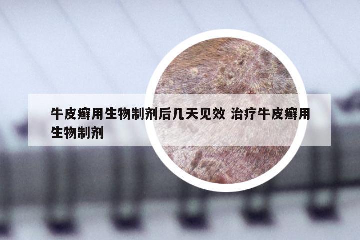 牛皮癣用生物制剂后几天见效 治疗牛皮癣用生物制剂