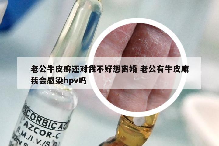 老公牛皮癣还对我不好想离婚 老公有牛皮廨我会感染hpv吗