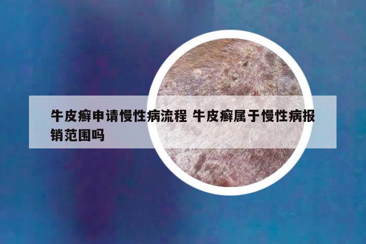 牛皮癣申请慢性病流程 牛皮癣属于慢性病报销范围吗