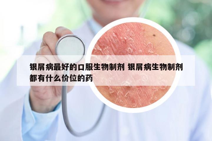 银屑病最好的口服生物制剂 银屑病生物制剂都有什么价位的药