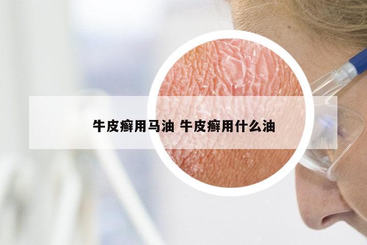 牛皮癣用马油 牛皮癣用什么油