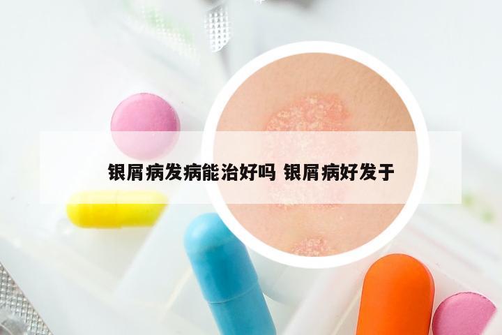 银屑病发病能治好吗 银屑病好发于