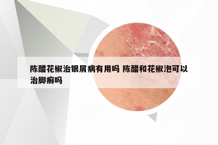 陈醋花椒治银屑病有用吗 陈醋和花椒泡可以治脚癣吗