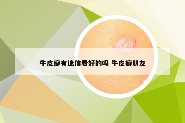 牛皮癣有迷信看好的吗 牛皮癣朋友