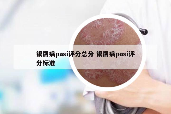 银屑病pasi评分总分 银屑病pasi评分标准