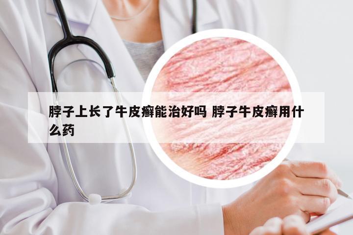 脖子上长了牛皮癣能治好吗 脖子牛皮癣用什么药