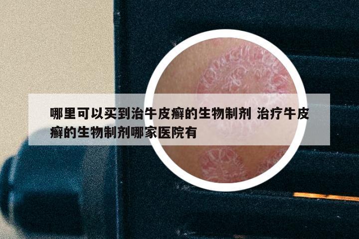 哪里可以买到治牛皮癣的生物制剂 治疗牛皮癣的生物制剂哪家医院有