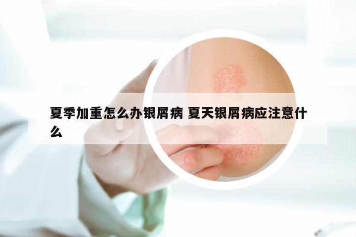 夏季加重怎么办银屑病 夏天银屑病应注意什么