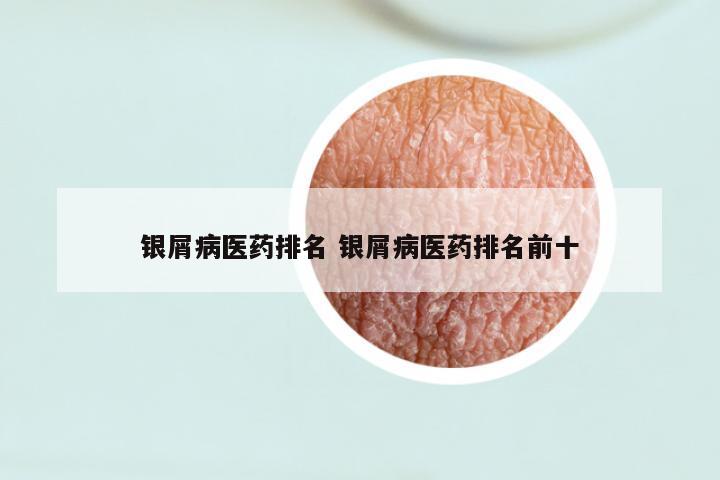 银屑病医药排名 银屑病医药排名前十