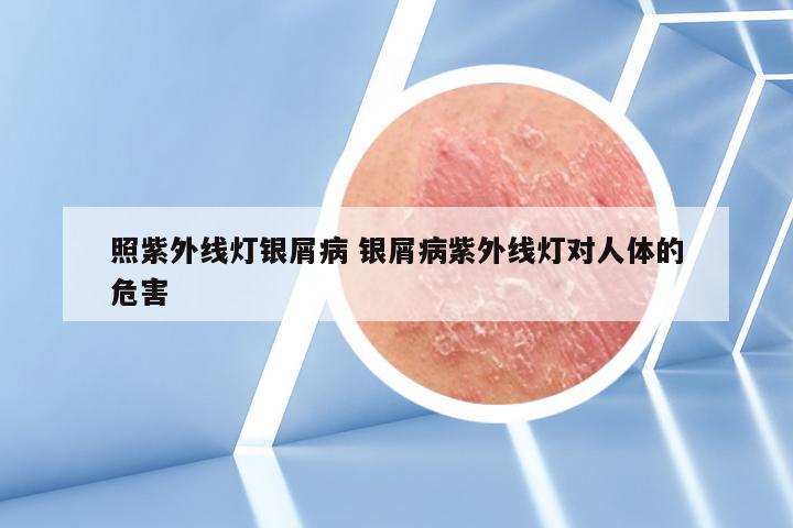 照紫外线灯银屑病 银屑病紫外线灯对人体的危害