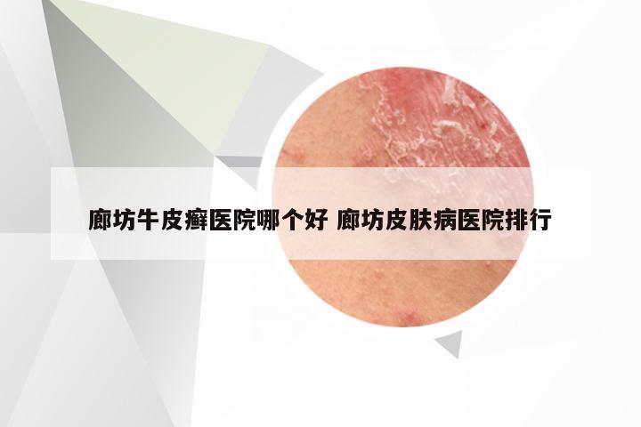 廊坊牛皮癣医院哪个好 廊坊皮肤病医院排行