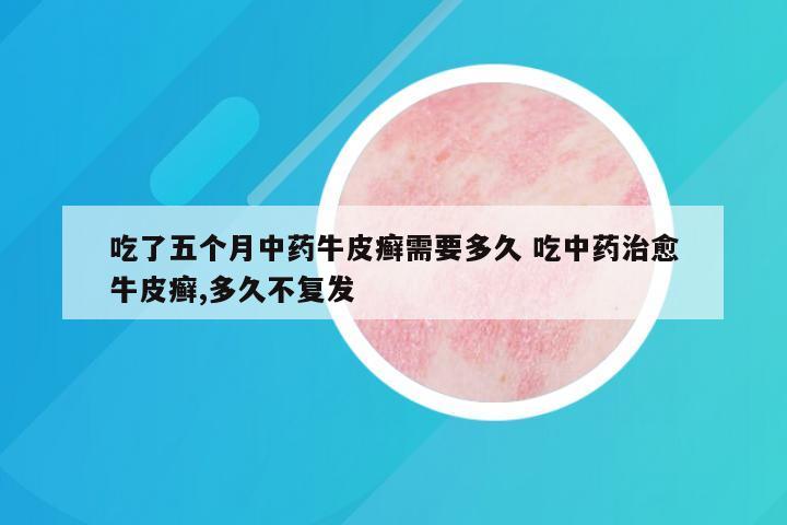吃了五个月中药牛皮癣需要多久 吃中药治愈牛皮癣,多久不复发