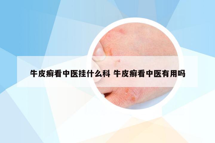 牛皮癣看中医挂什么科 牛皮癣看中医有用吗