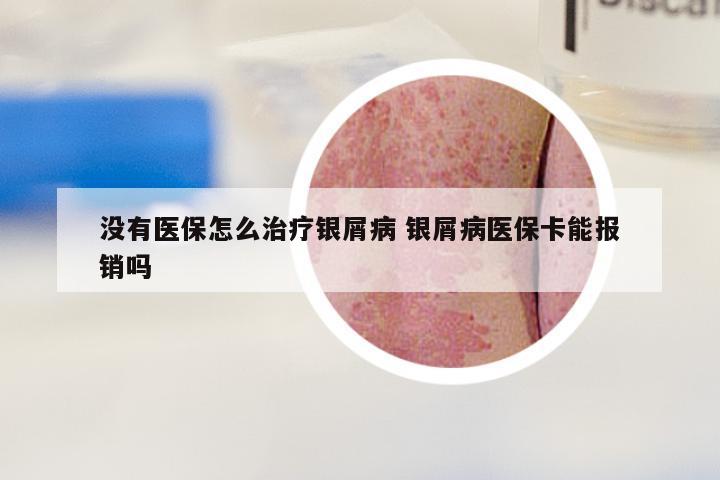 没有医保怎么治疗银屑病 银屑病医保卡能报销吗