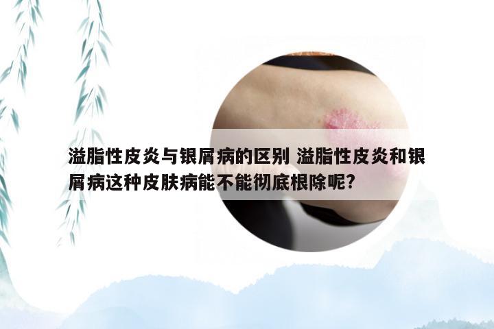 溢脂性皮炎与银屑病的区别 溢脂性皮炎和银屑病这种皮肤病能不能彻底根除呢?