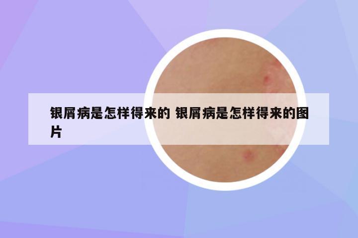 银屑病是怎样得来的 银屑病是怎样得来的图片