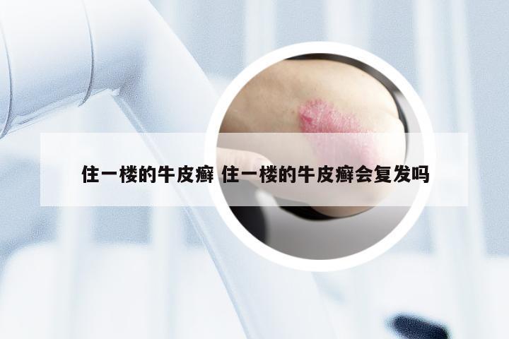 住一楼的牛皮癣 住一楼的牛皮癣会复发吗