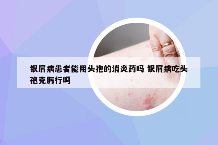银屑病患者能用头孢的消炎药吗 银屑病吃头孢克肟行吗