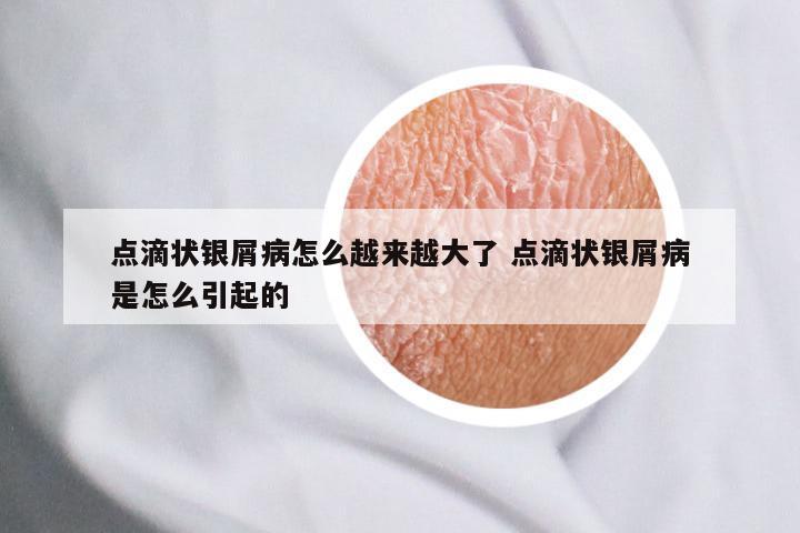 点滴状银屑病怎么越来越大了 点滴状银屑病是怎么引起的