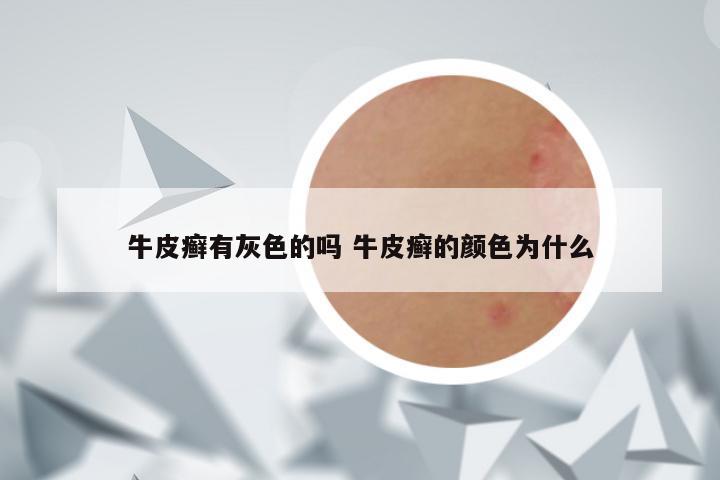牛皮癣有灰色的吗 牛皮癣的颜色为什么