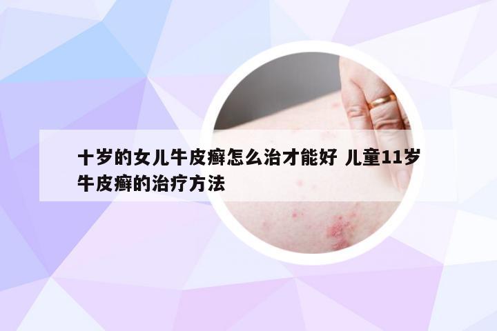 十岁的女儿牛皮癣怎么治才能好 儿童11岁牛皮癣的治疗方法