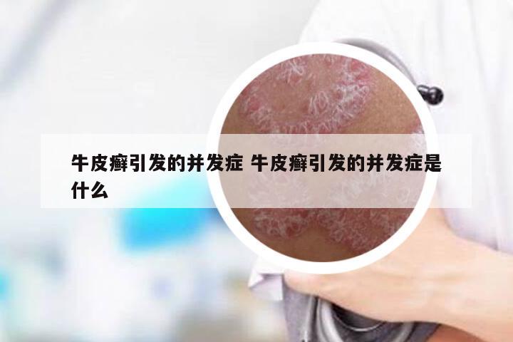 牛皮癣引发的并发症 牛皮癣引发的并发症是什么