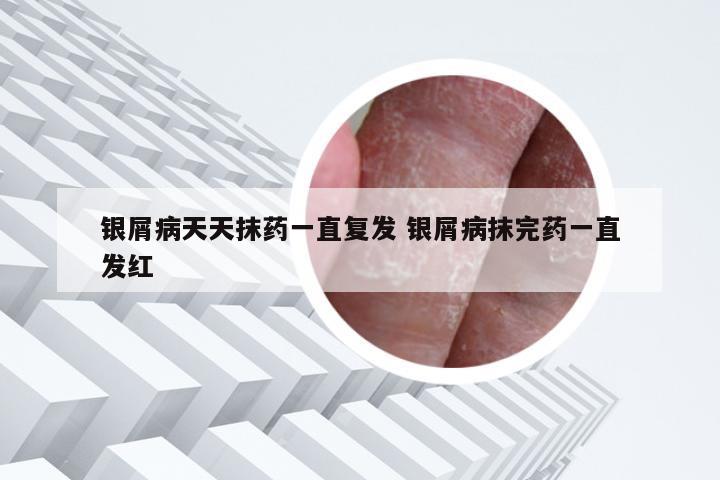 银屑病天天抹药一直复发 银屑病抹完药一直发红