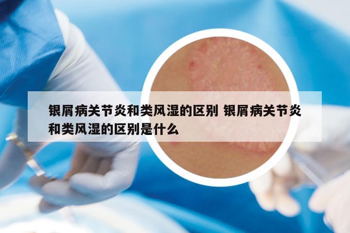 银屑病关节炎和类风湿的区别 银屑病关节炎和类风湿的区别是什么