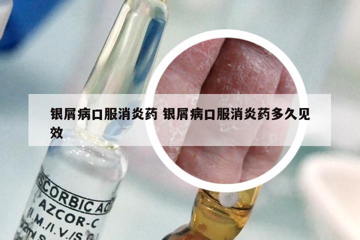银屑病口服消炎药 银屑病口服消炎药多久见效