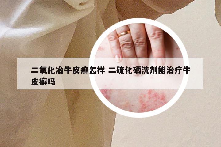 二氧化冶牛皮癣怎样 二硫化硒洗剂能治疗牛皮癣吗