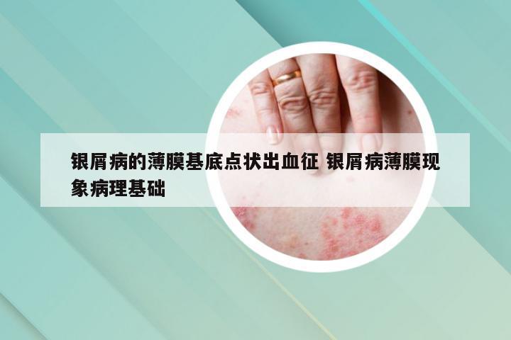 银屑病的薄膜基底点状出血征 银屑病薄膜现象病理基础