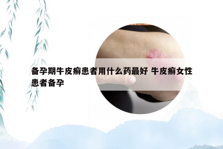备孕期牛皮癣患者用什么药最好 牛皮癣女性患者备孕