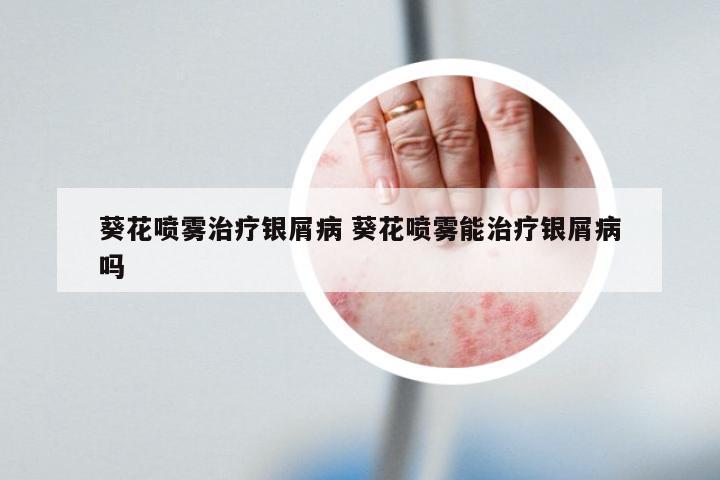 葵花喷雾治疗银屑病 葵花喷雾能治疗银屑病吗
