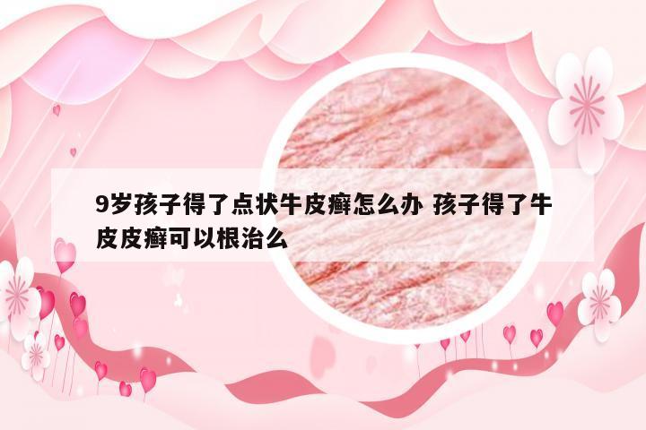 9岁孩子得了点状牛皮癣怎么办 孩子得了牛皮皮癣可以根治么