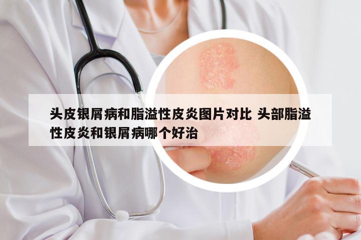 头皮银屑病和脂溢性皮炎图片对比 头部脂溢性皮炎和银屑病哪个好治