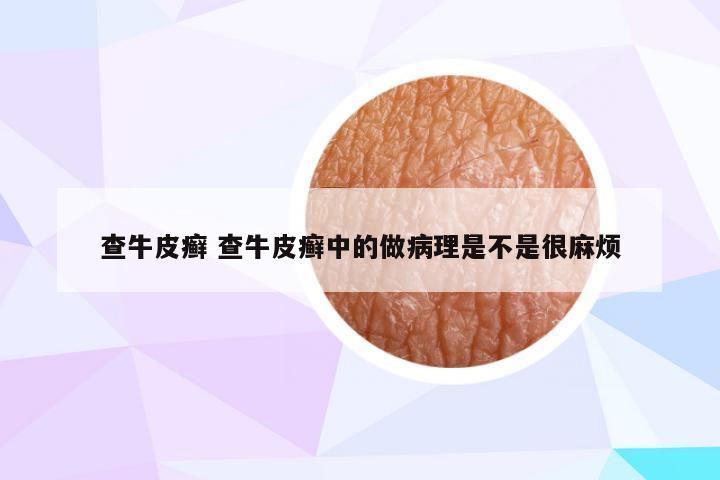 查牛皮癣 查牛皮癣中的做病理是不是很麻烦