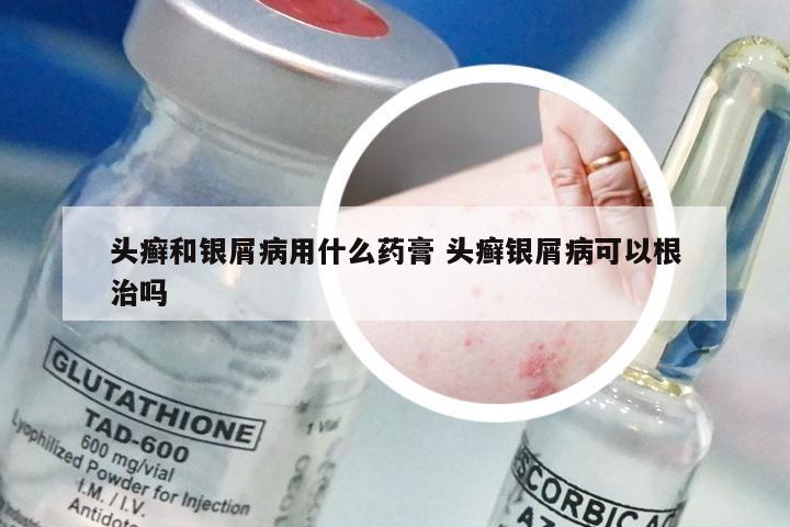 头癣和银屑病用什么药膏 头癣银屑病可以根治吗
