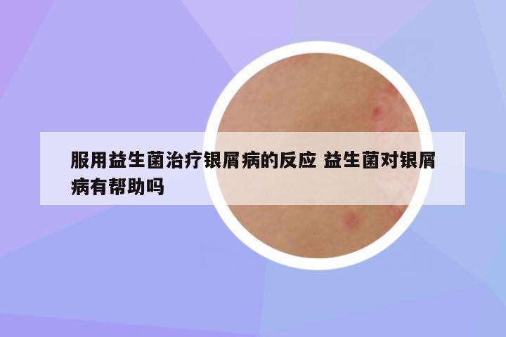 服用益生菌治疗银屑病的反应 益生菌对银屑病有帮助吗