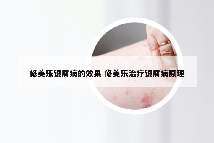 修美乐银屑病的效果 修美乐治疗银屑病原理