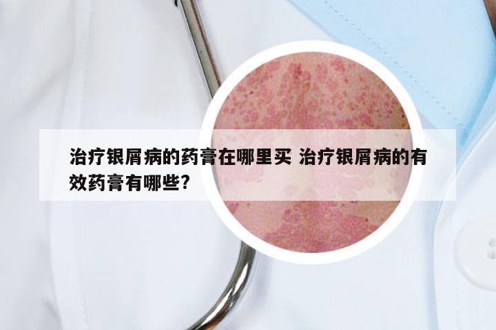 治疗银屑病的药膏在哪里买 治疗银屑病的有效药膏有哪些?