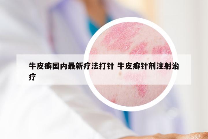 牛皮癣国内最新疗法打针 牛皮癣针剂注射治疗