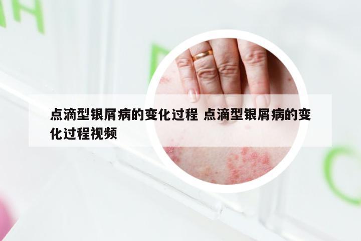 点滴型银屑病的变化过程 点滴型银屑病的变化过程视频
