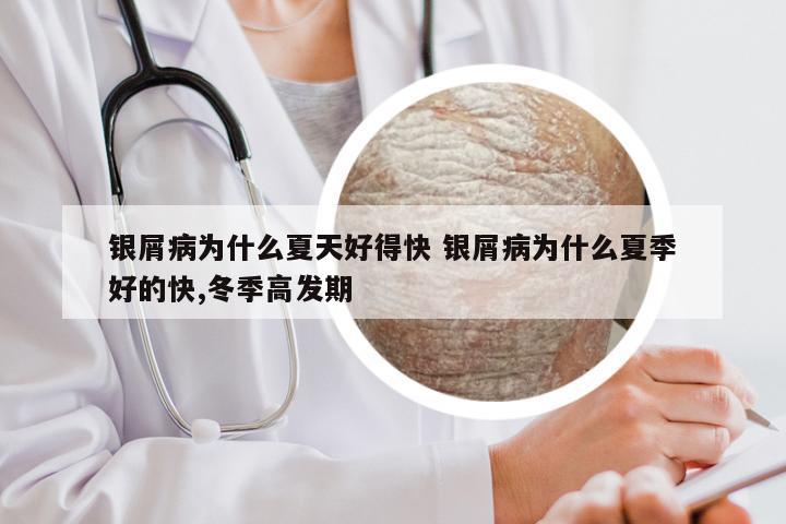 银屑病为什么夏天好得快 银屑病为什么夏季好的快,冬季高发期