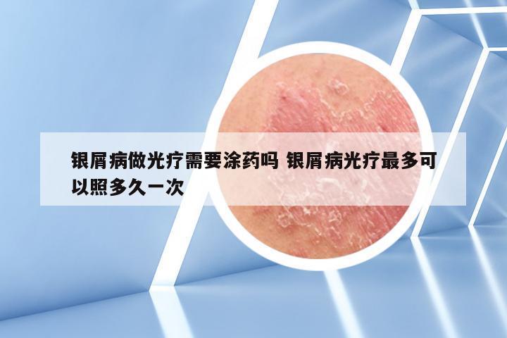 银屑病做光疗需要涂药吗 银屑病光疗最多可以照多久一次