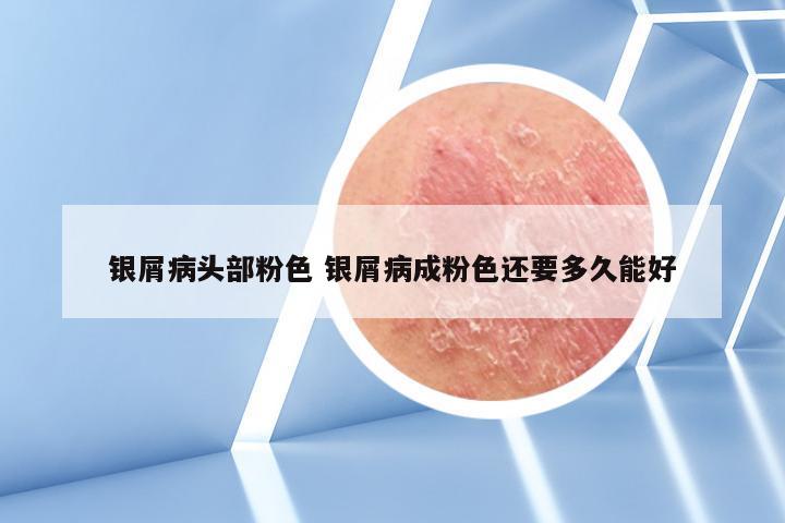 银屑病头部粉色 银屑病成粉色还要多久能好