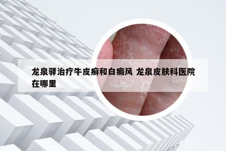 龙泉驿治疗牛皮癣和白癜风 龙泉皮肤科医院在哪里