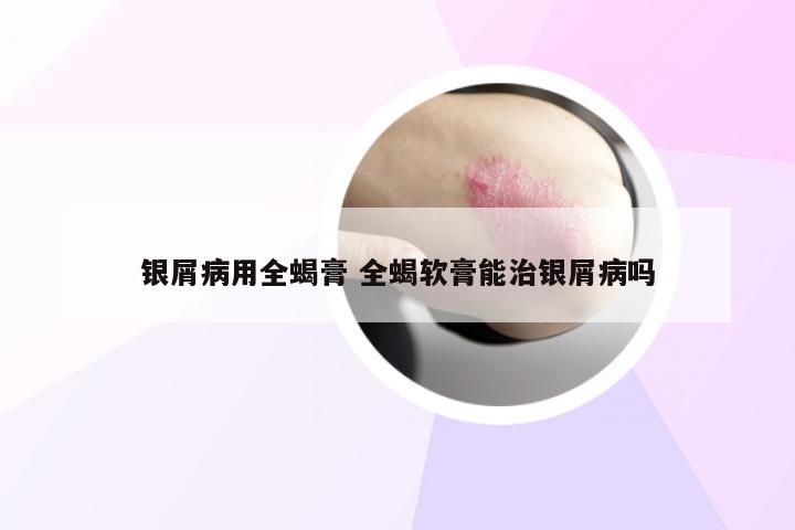 银屑病用全蝎膏 全蝎软膏能治银屑病吗