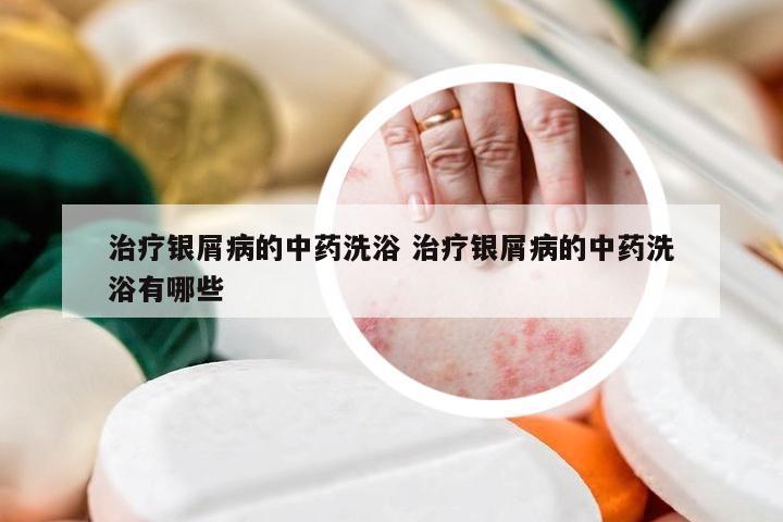 治疗银屑病的中药洗浴 治疗银屑病的中药洗浴有哪些